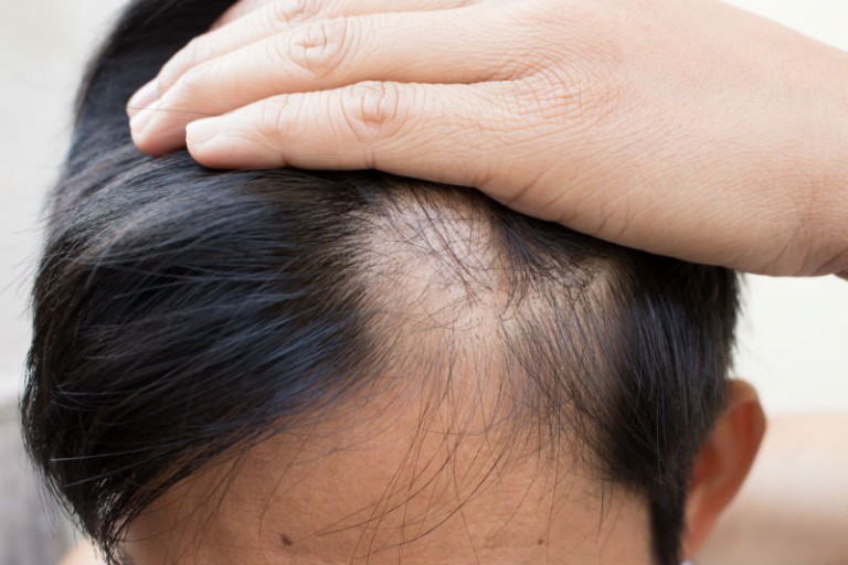 Why Hair Restoration in NYC is An Excellent Solution for Many